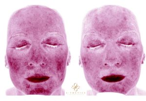 rosacea-before-and-after-at-S-Thetics-Clinic-Beaconsfield-Miss-Sherina-Balaratnam-Allergan-Faculty-Doctor
