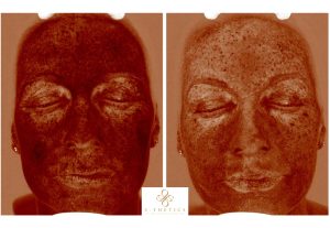 sun-damage-before-and-after-at-S-Thetics-Clinic-Beaconsfield-Miss-Sherina-Balaratnam-Allergan-Faculty-Doctor