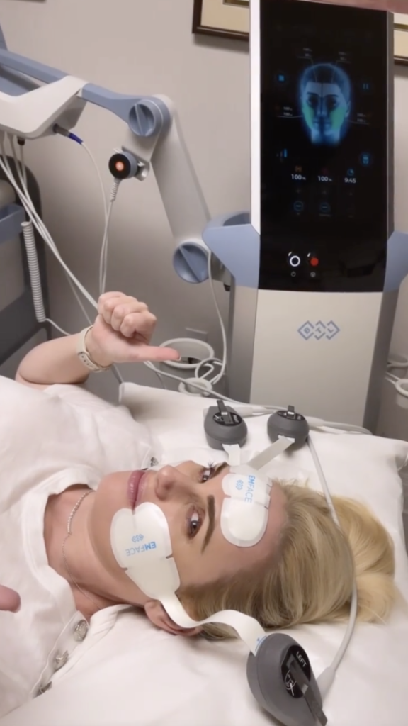 EMFACE-at-S-Thetics-Clinic-Rebel-Wilson-shares-her-EMFACE-experience-and-results